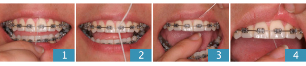 uso de hilo dental con ortodoncia Madrid
