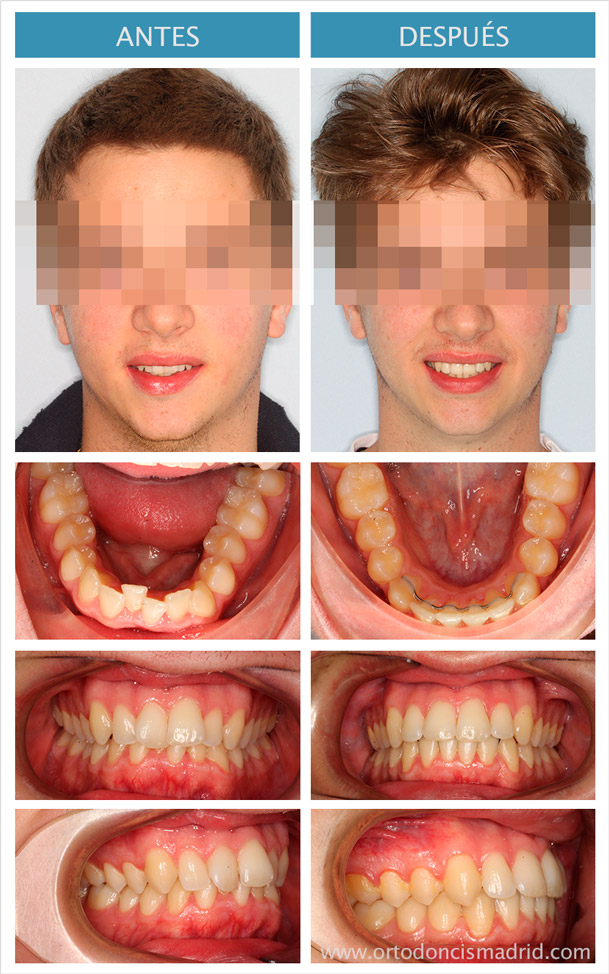 Caso de apiñamiento moderado corregido con ortodoncia lingual incognito