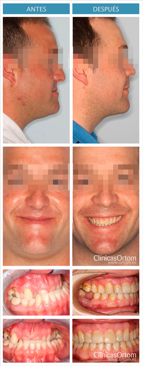 Sorprendentes cambios faciales tras cirugía y ortodoncia