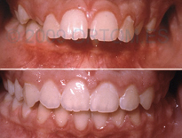 caso ortodoncia infantil madrid ortom 07