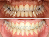 ortodoncia adultos ortom madrid 05