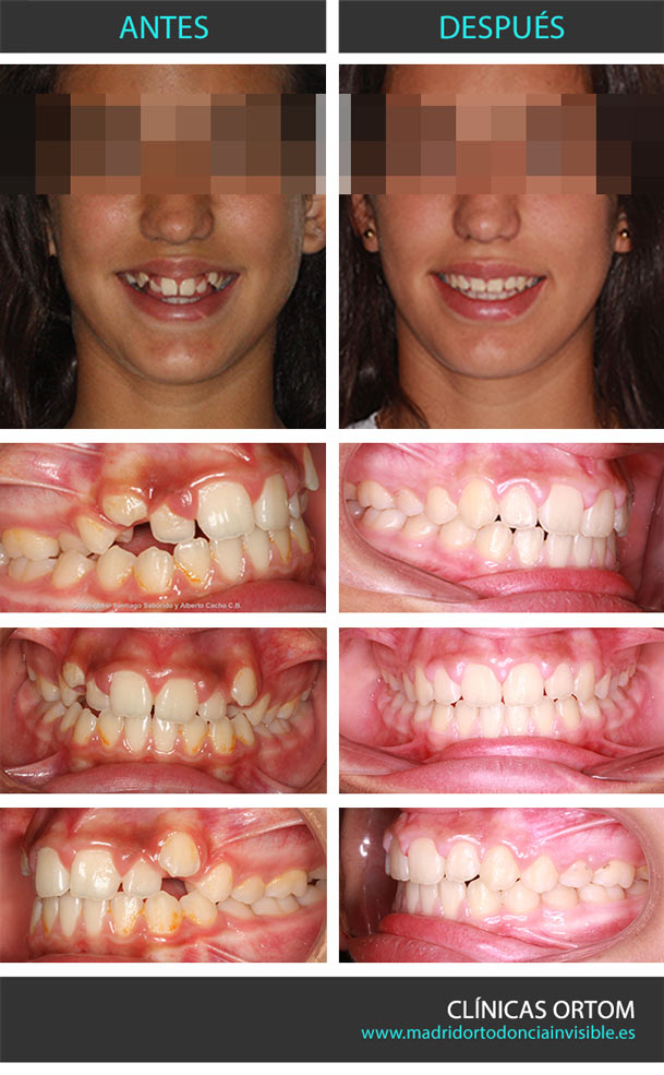 ortodoncia estética adolescente